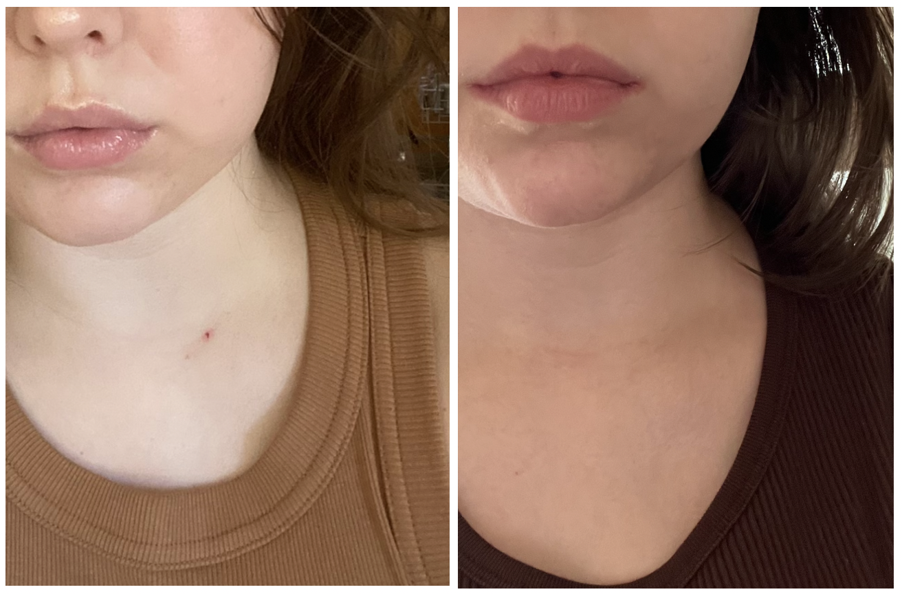 Broken capillary (on chest) before and after Versapulse laser treatment