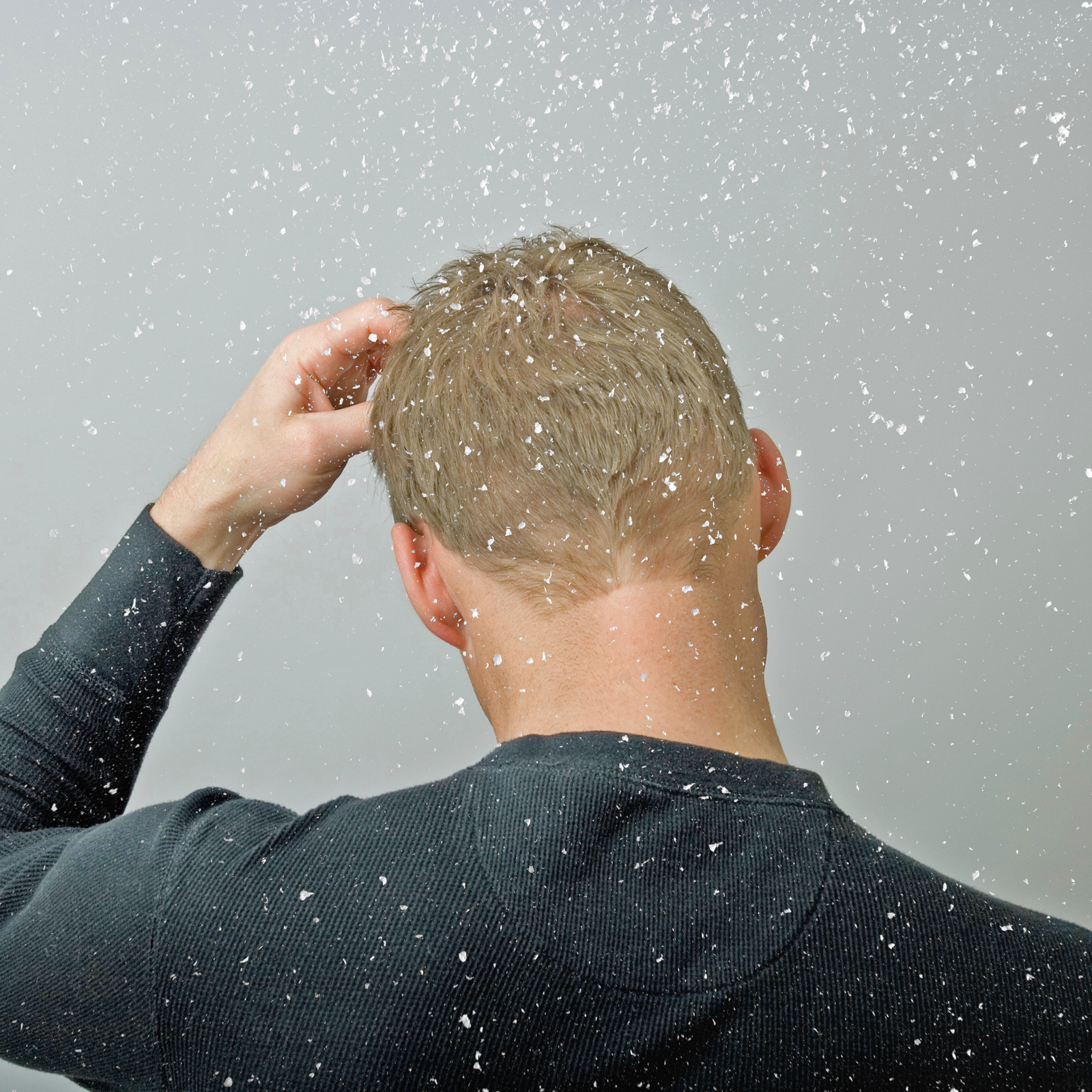 So sorry, this one is about “stress-induced dandruff”