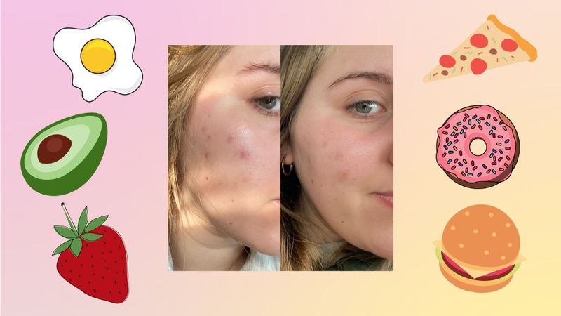 Can an anti-inflammatory diet help with cystic acne? We tried it out for a month to find out