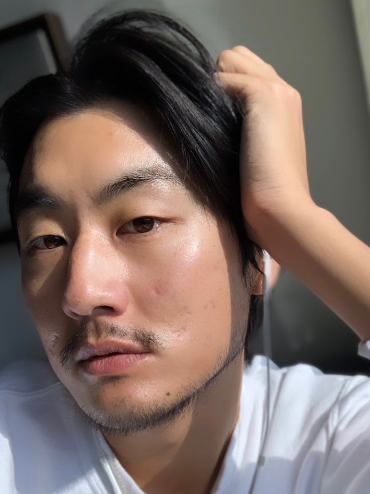 Asian man tretinoin acne results