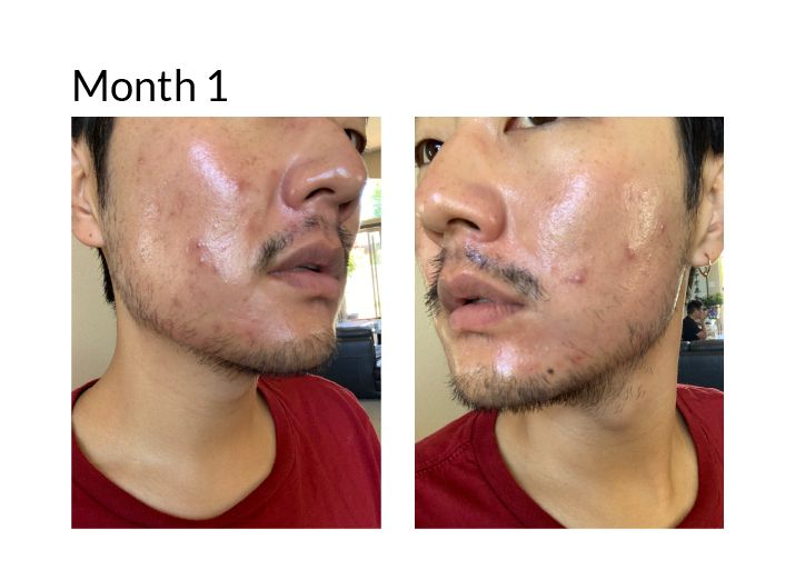 Tretinoin results asian man month 1