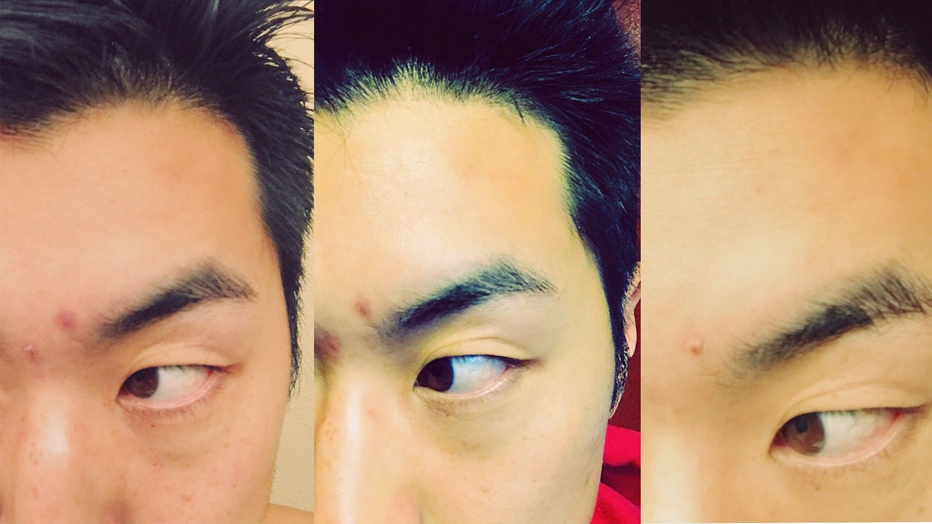 How To Pop A Pimple Properly, Even Though You Really Shouldn't | Teen Vogue