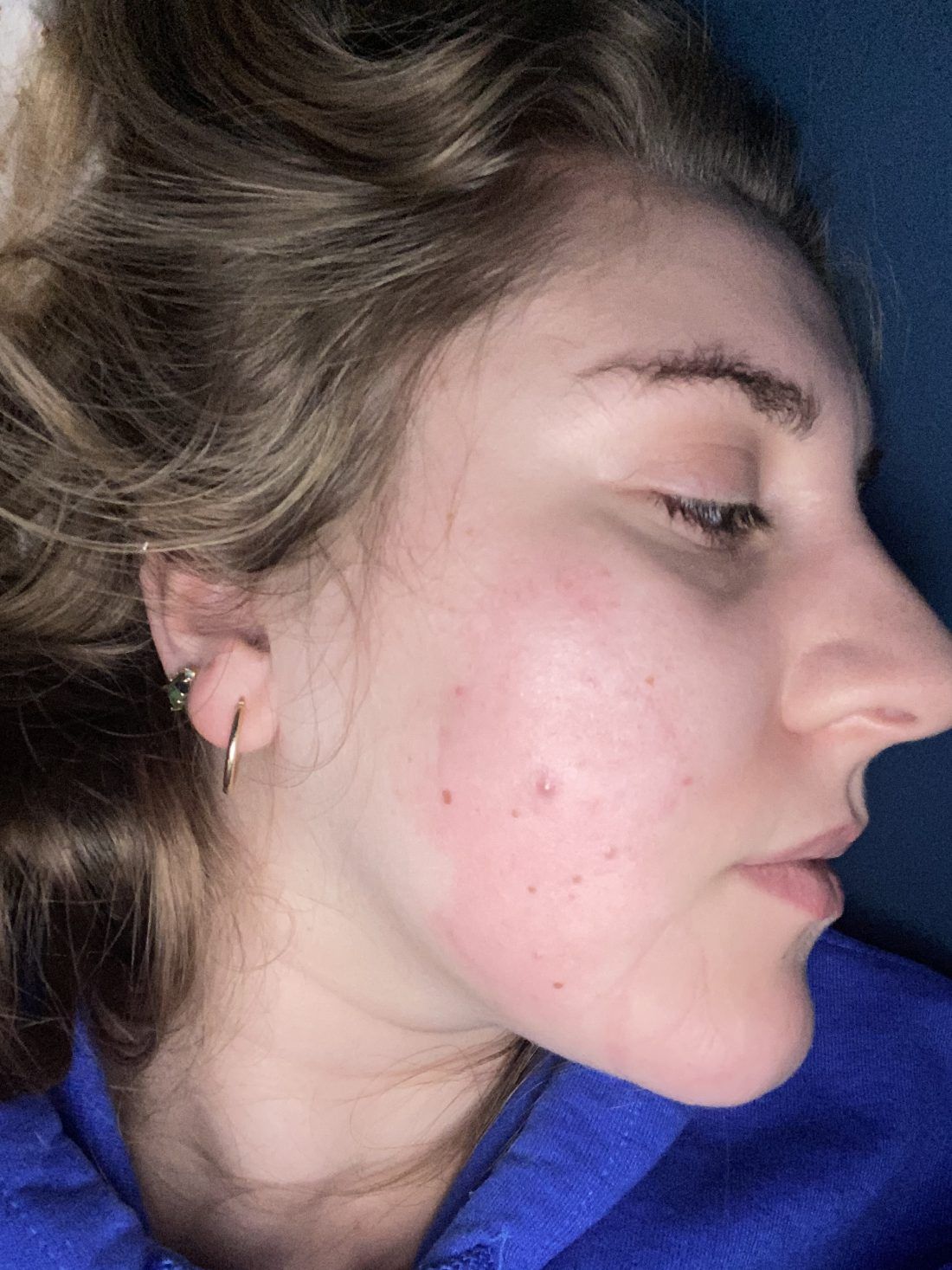 Bandages for acne? Experts weigh in on viral TikTok hack - ABC News